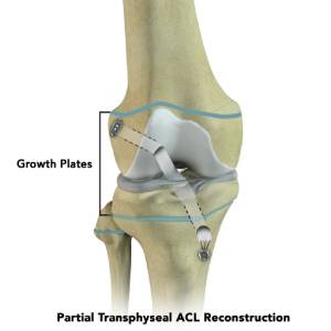 Partial Transphyseal Surgery