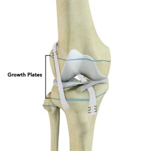 Physeal Sparing Surgery 