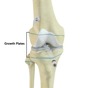 Transphyseal ACL Reconstruction